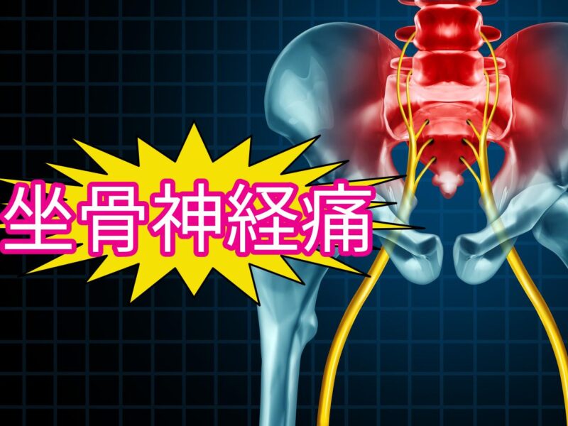 坐骨神経痛