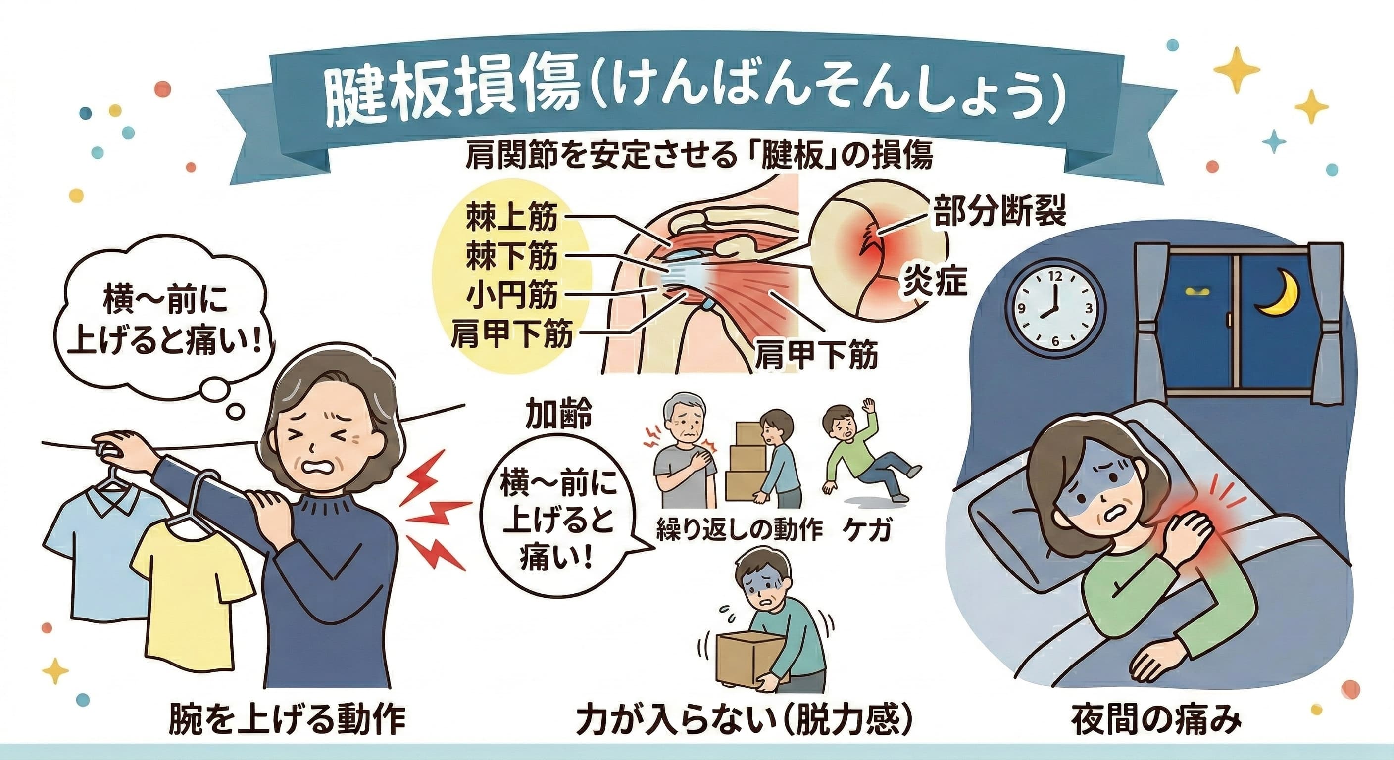 腱板損傷のイメージ